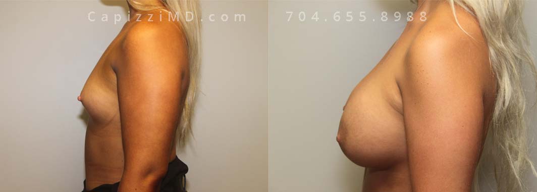 Breast Augmentation, 23/5’6”/140 lbs, Sientra Smooth Round HP 505cc