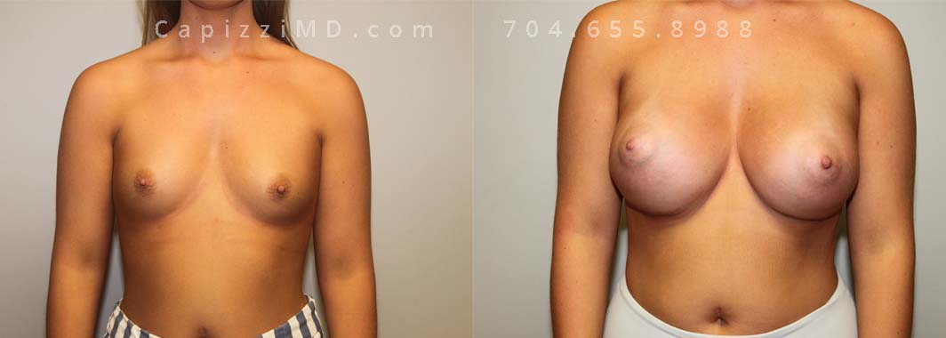 Breast Augmentation, 23/5’66/140 lbs, Sientra Smooth Round HP 505cc