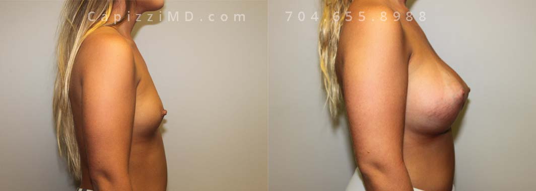 Breast Augmentation, 23/5’66/140 lbs, Sientra Smooth Round HP 505cc