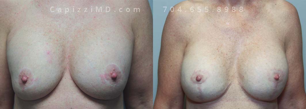 Breast Augmentation + Full Lift + Internal Mesh, 52/5’8”/170 lbs, Sientra Smooth Round HP 535cc