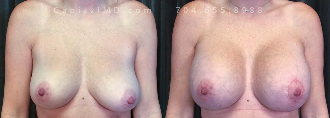 Breast Augmentation + Modified Lift, 35/5’8”/145 lbs, Sientra Smooth Round HP 440cc