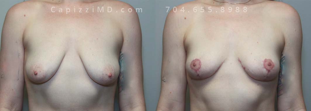 Breast Lift, 31/5’7”/130 lbs, Full Breast Lift