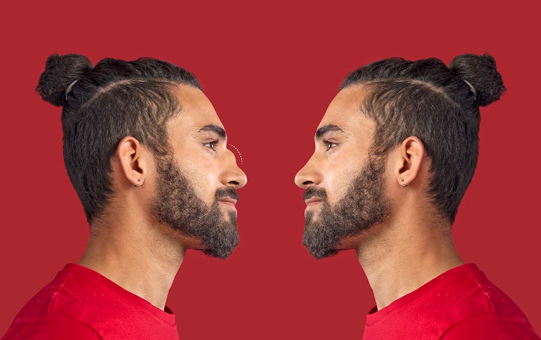 Before and After Comparison of a Man with an Ultrasonic Rhinoplasty