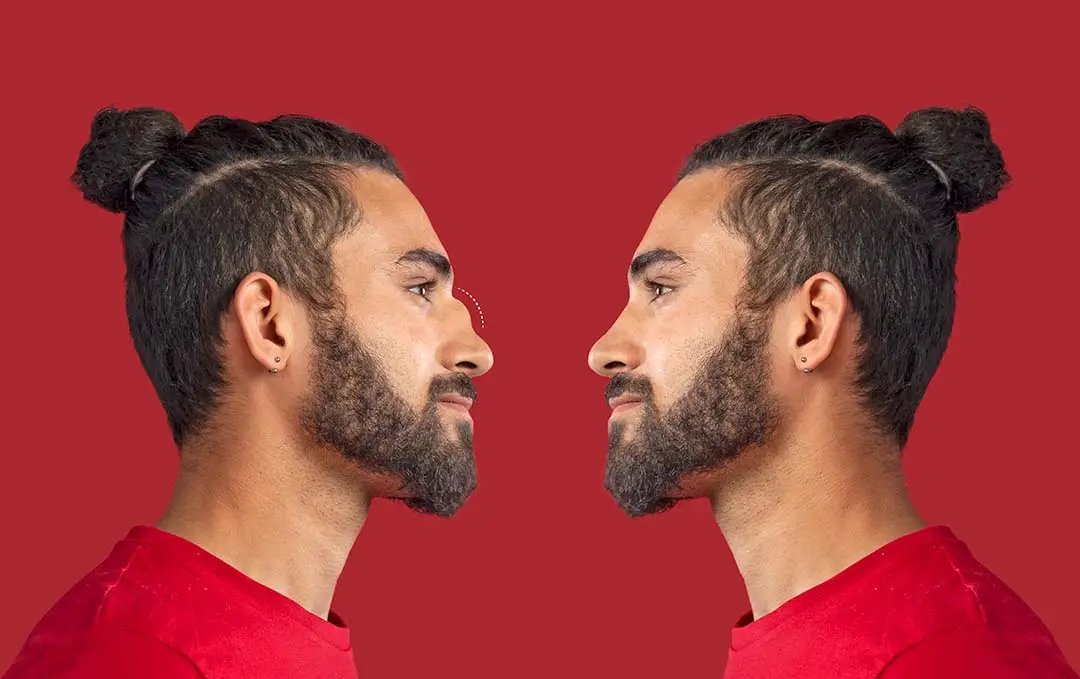Before and After Comparison of a Man with an Ultrasonic Rhinoplasty