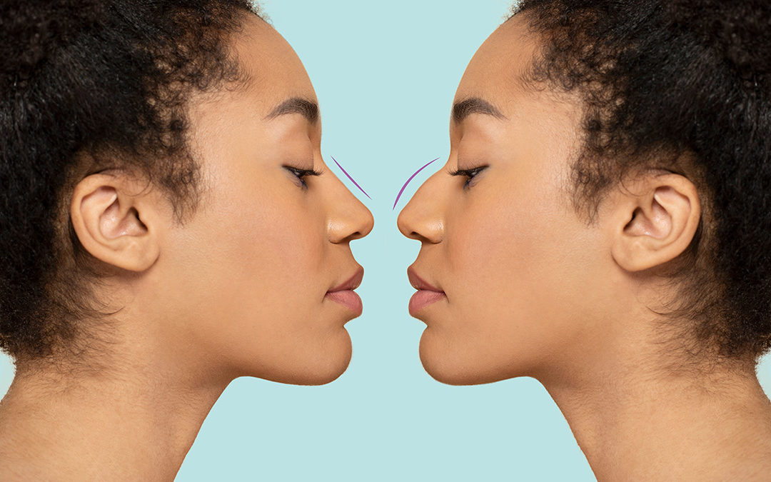 Before and After a Nose Job (Liquid Rhinoplasty) Mirror Image.