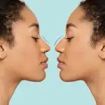 Before and After a Nose Job (Liquid Rhinoplasty) Mirror Image.