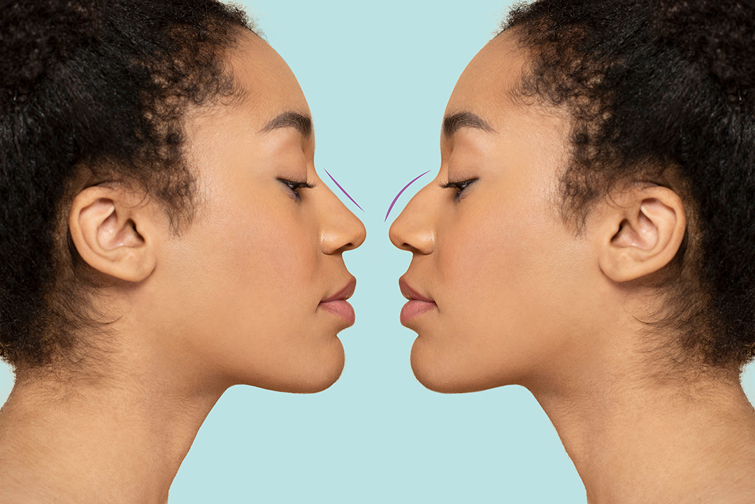 Before and After a Nose Job (Liquid Rhinoplasty) Mirror Image.
