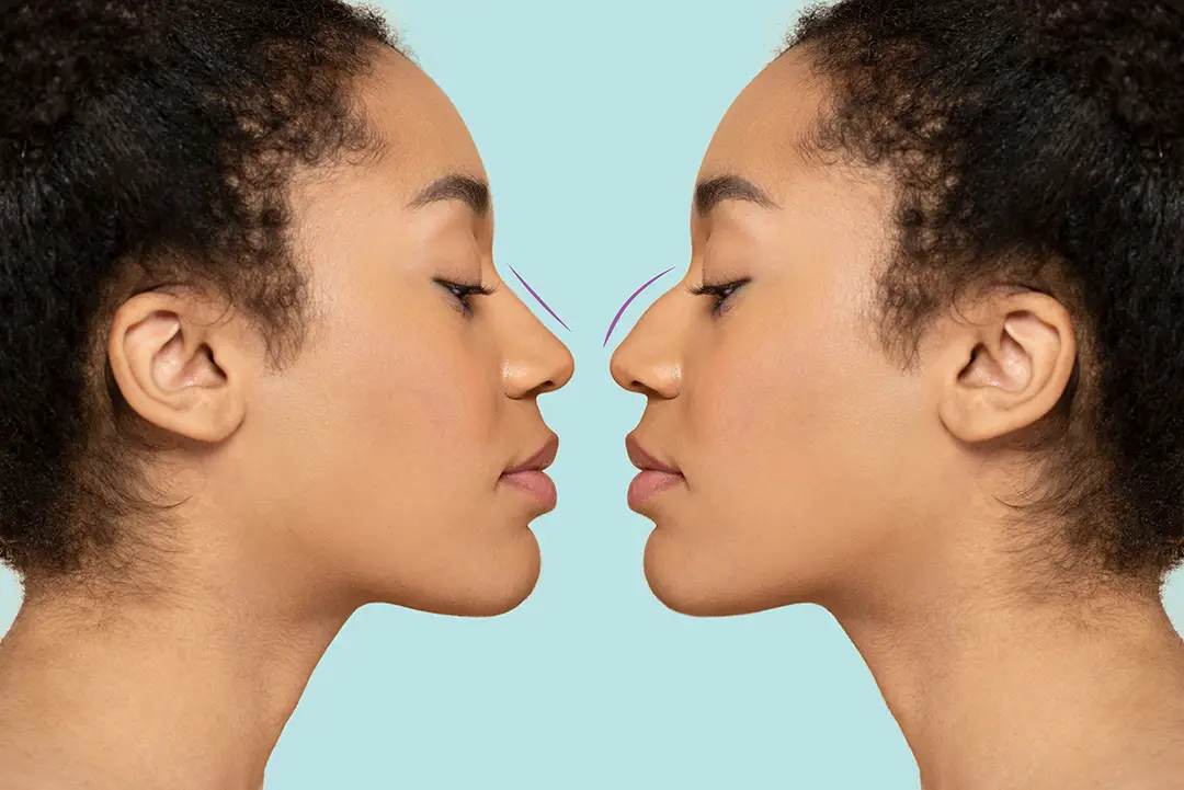 Before and After a Nose Job (Liquid Rhinoplasty) Mirror Image.
