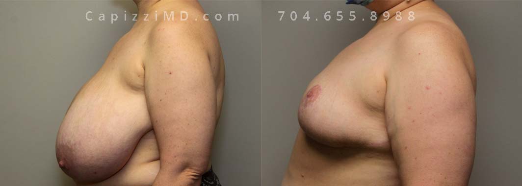 Breast Reduction with Free Nipple Graft. Age: 42; Height: 5’8”; Weight: 250 lbs.