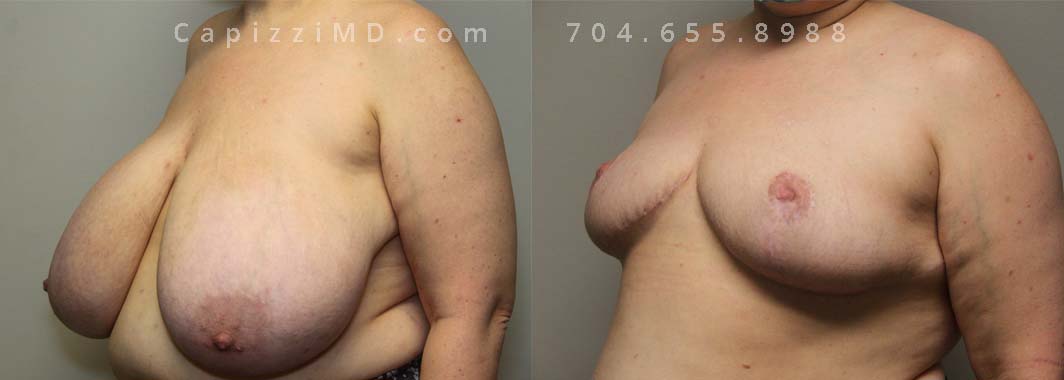 Breast Reduction with Free Nipple Graft. Age: 42; Height: 5’8”; Weight: 250 lbs.