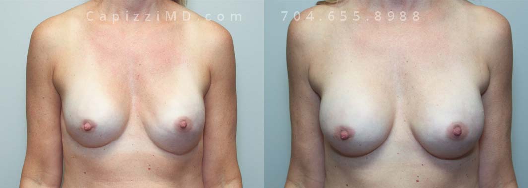 Implant Exchange from Shaped to Sientra Smooth Round HP; 385cc HSC + Internal Mesh Bra; Age: 47; Height: 5’2”; Weight: 120 lbs