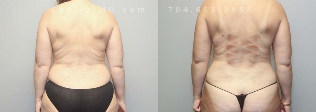 BA w/Mini-Lift (R-SIDE), Tummy Tuck; Liposuction Abdomen/Posterior/Hips/Thighs/Bra Roll. Age 43, Height 5’ 6”, Weight 175 lbs.