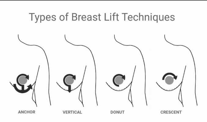Types of Breast Lift Techniques