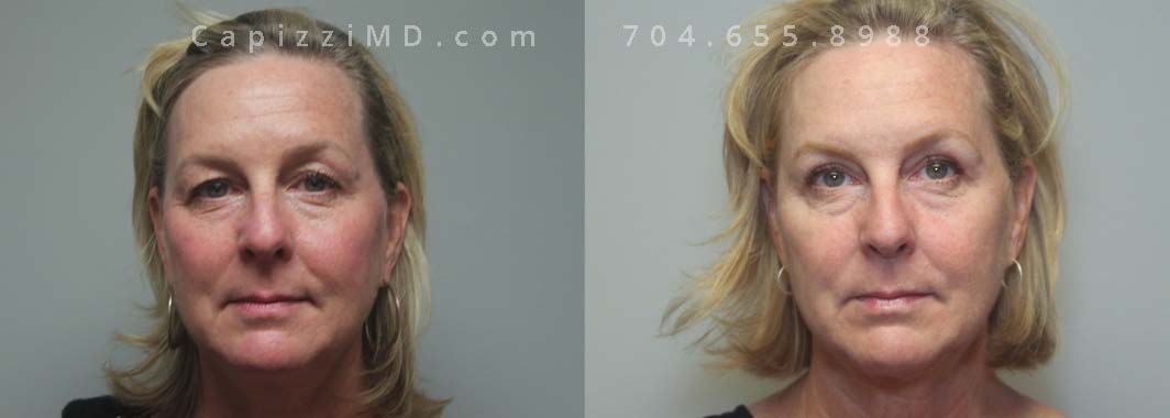 Face: Upper Blepharoplasty, Hairline Browlift, Profound Skin Tightening, Kybella; Age: 56; Height: 5’ 7”; Weight: 160 lbs.