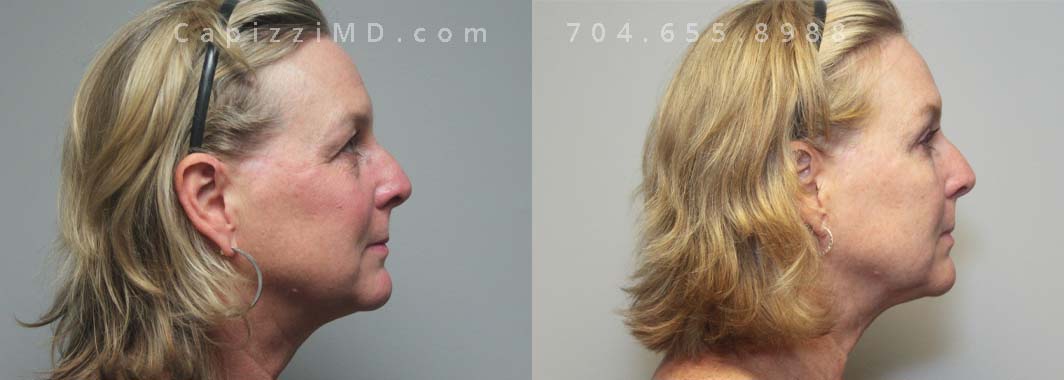 Face: Upper Blepharoplasty, Hairline Browlift, Profound Skin Tightening, Kybella; Age: 56; Height: 5’ 7”; Weight: 160 lbs.
