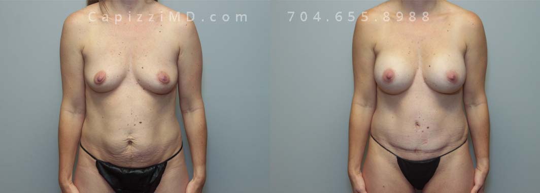 Breast Augmentation and Standard Tummy Tuck. Sientra Smooth Round HP 280cc. Age: 42 Height: 5' Weight: 115.