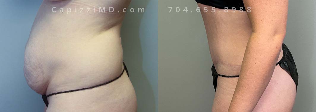 Standard tummy tuck with liposuction to posterior hips and lateral abdomen. Age:35 Height:5'2" Weight: 135 lbs.