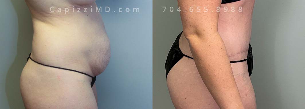 Standard tummy tuck with liposuction to posterior hips and lateral abdomen. Age:35 Height:5'2" Weight: 135 lbs.