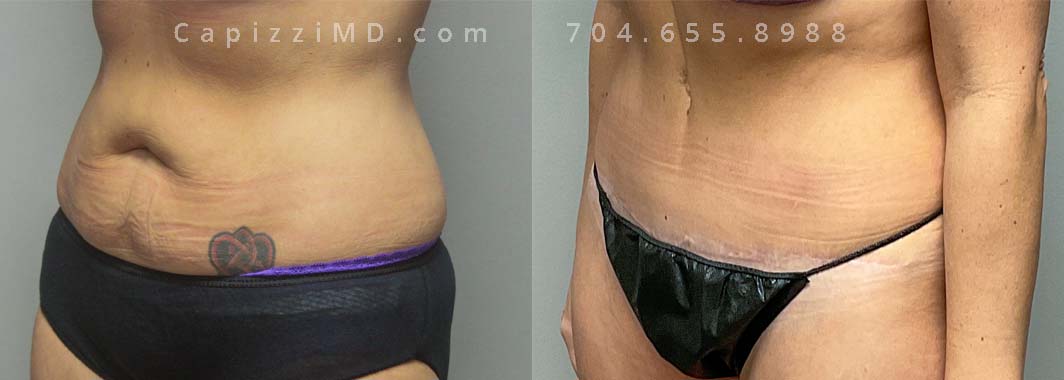 Standard tummy tuck and liposuction to abdomen and posterior hips Age: 38 Height: 5'4" Weight: 146.