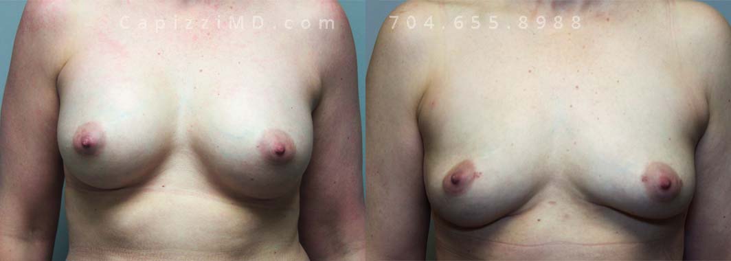 Implant Removal, Age: 46, Height: 5’10”, Weight: 163 lbs.