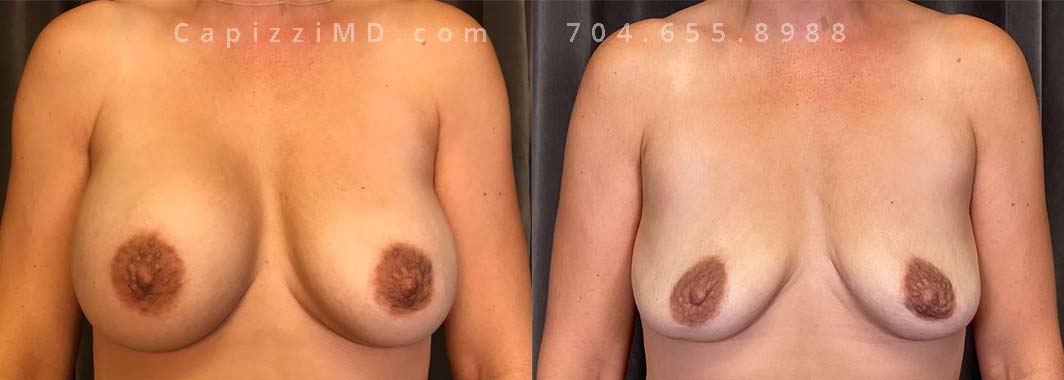 Implant Removal, Age: 46, Height: 5’6”, Weight: 145 lbs.