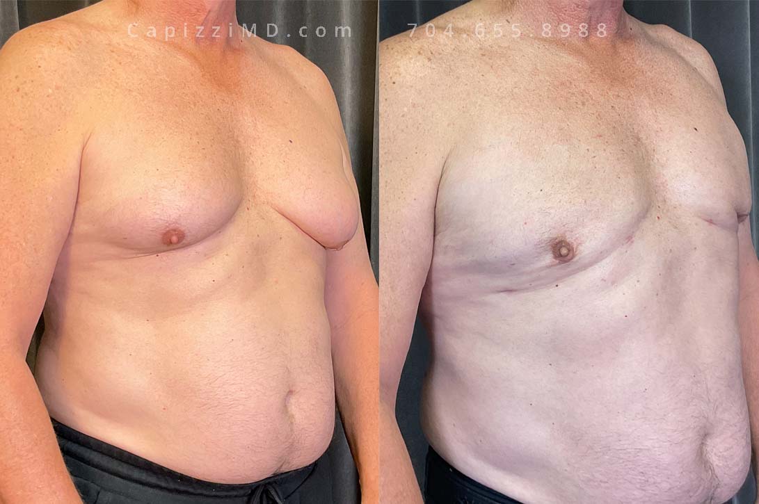 Gynecomastia Before & After Photos Charlotte North Carolina