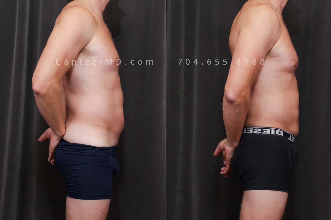 This patient had liposuction to his abdomen and posterior hips to slim and contour his abdominal muscles and give him a more masculine figure.
