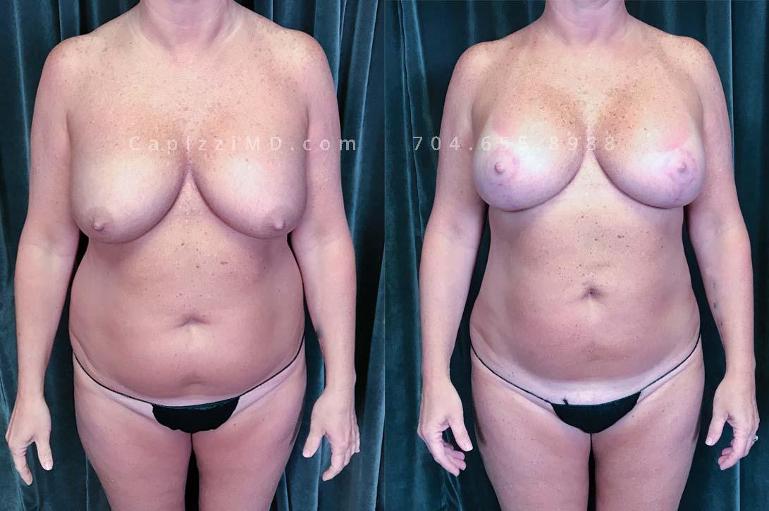 This patient had an implant exchange/breast revision to replace implants that were not positioned properly. She also had liposuction to flatten the appearance of her abdomen and love handles, erase her bra roll, and contour her inner/outer thighs.