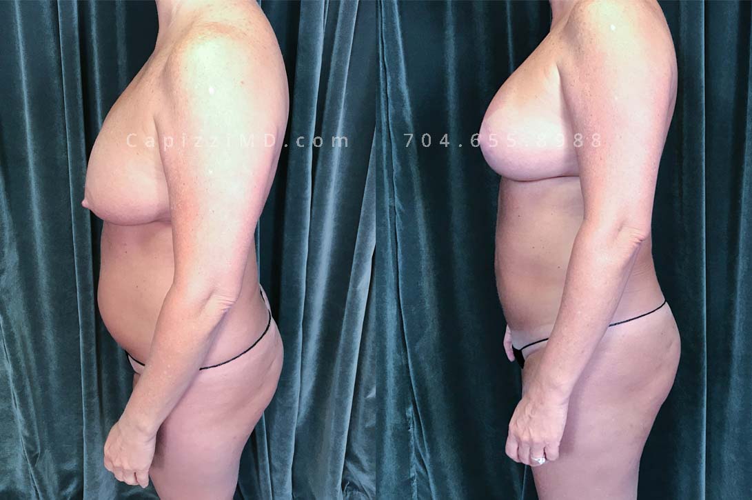 This patient had an implant exchange/breast revision to replace implants that were not positioned properly. She also had liposuction to flatten the appearance of her abdomen and love handles, erase her bra roll, and contour her inner/outer thighs.