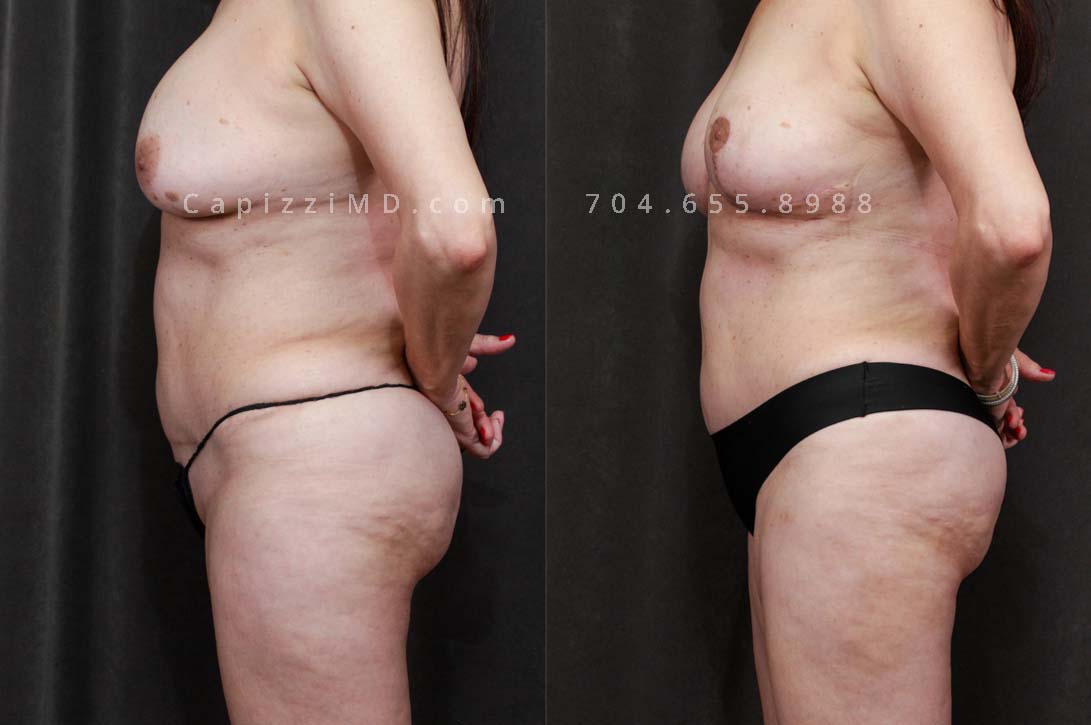 This patient received a breast revision with modified lift and liposuction to her bra roll, posterior hips, and inner/outer thighs. You'll notice a smoother transition from her hips to her thighs and a more pronounced buttocks from her body contouring.