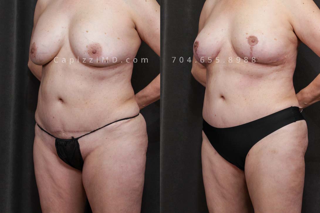 This patient received a breast revision with modified lift and liposuction to her bra roll, posterior hips, and inner/outer thighs. You'll notice a smoother transition from her hips to her thighs and a more pronounced buttocks from her body contouring.