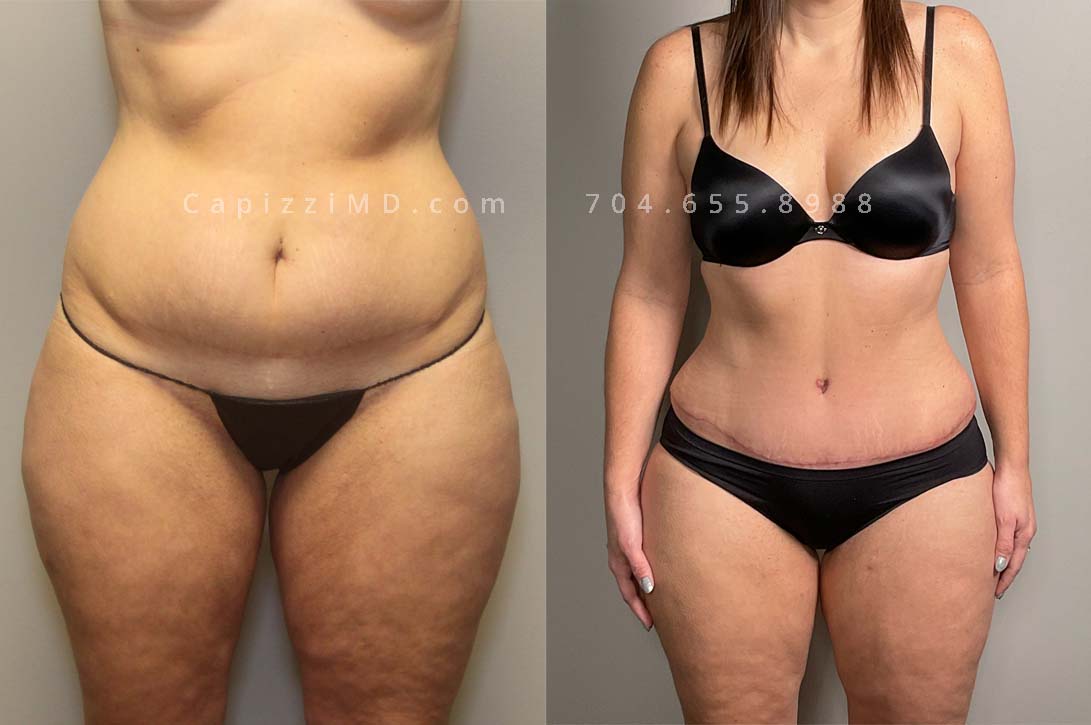 This patient wanted to smooth her belly and upper legs. She received a tummy tuck which revised an existing c-section scar and liposuction to her inner thighs, posterior hips, bra roll, and flanks. *Scars are pink as she is only 3 months out from surgery, scars fade to skin color in 12-18 months.