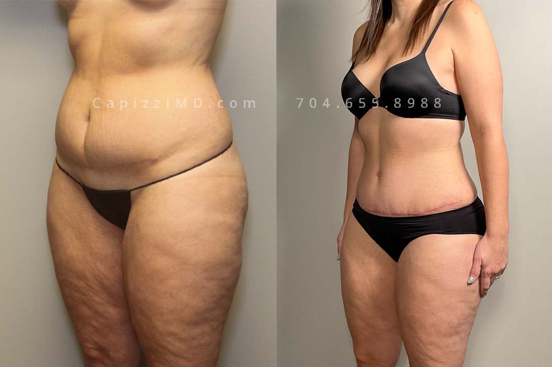 This patient wanted to smooth her belly and upper legs. She received a tummy tuck which revised an existing c-section scar and liposuction to her inner thighs, posterior hips, bra roll, and flanks. *Scars are pink as she is only 3 months out from surgery, scars fade to skin color in 12-18 months.