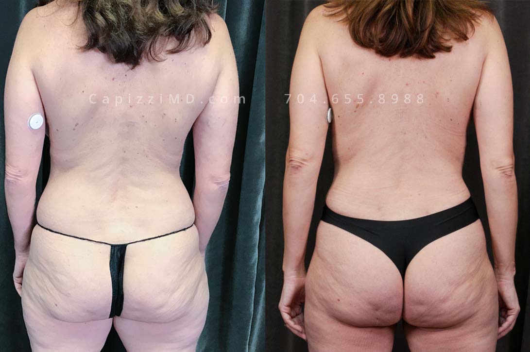 This patient received a full breast lift, tummy tuck, and liposuction to her abdomen, posterior hips, bra roll, and inner/outer thighs. You will notice lifted, perkier breasts with a tighter waist and slimmer thighs.