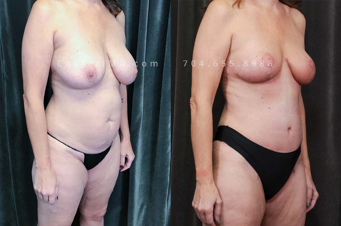 This patient received a full breast lift, tummy tuck, and liposuction to her abdomen, posterior hips, bra roll, and inner/outer thighs. You will notice lifted, perkier breasts with a tighter waist and slimmer thighs.