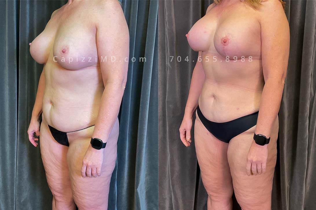 This patient received a breast revision/implant exchange, modified breast lift, and liposuction to her abdomen, posterior hips, bra roll, and inner/outer thighs. You'll notice a flatter abdomen, smoother contour in her thighs, and more definition in the transition from back to buttocks.