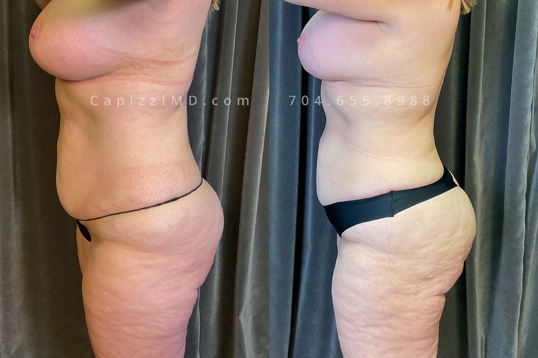 This patient received a breast revision/implant exchange, modified breast lift, and liposuction to her abdomen, posterior hips, bra roll, and inner/outer thighs. You'll notice a flatter abdomen, smoother contour in her thighs, and more definition in the transition from back to buttocks.