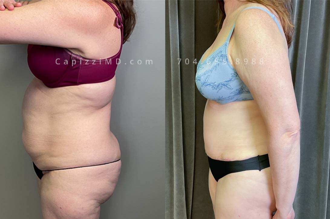 This patient had a standard tummy tuck to remove excess skin and fat, as well as repair diastasis recti. She also received liposuction to the posterior hips, abdomen, and thighs which smoothed the transitions from her abdomen to her legs, and abdomen to her breasts/back.