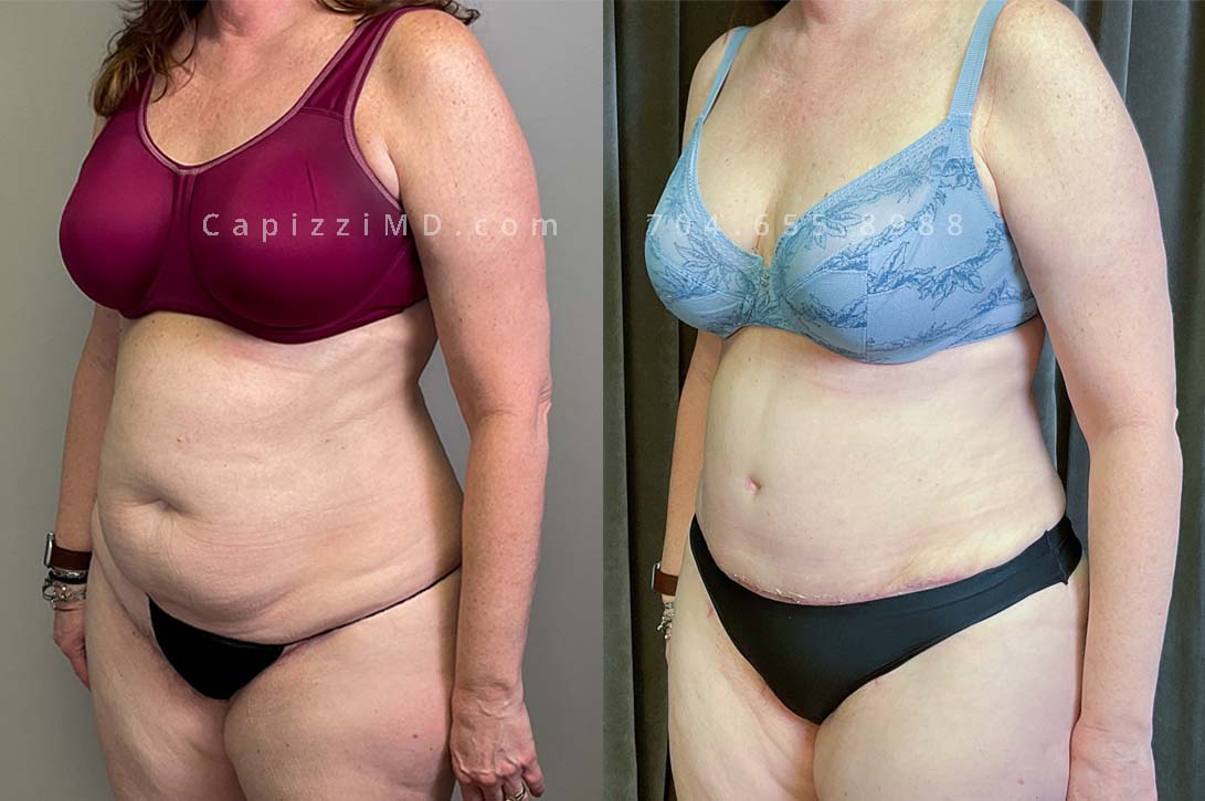 This patient had a standard tummy tuck to remove excess skin and fat, as well as repair diastasis recti. She also received liposuction to the posterior hips, abdomen, and thighs which smoothed the transitions from her abdomen to her legs, and abdomen to her breasts/back.