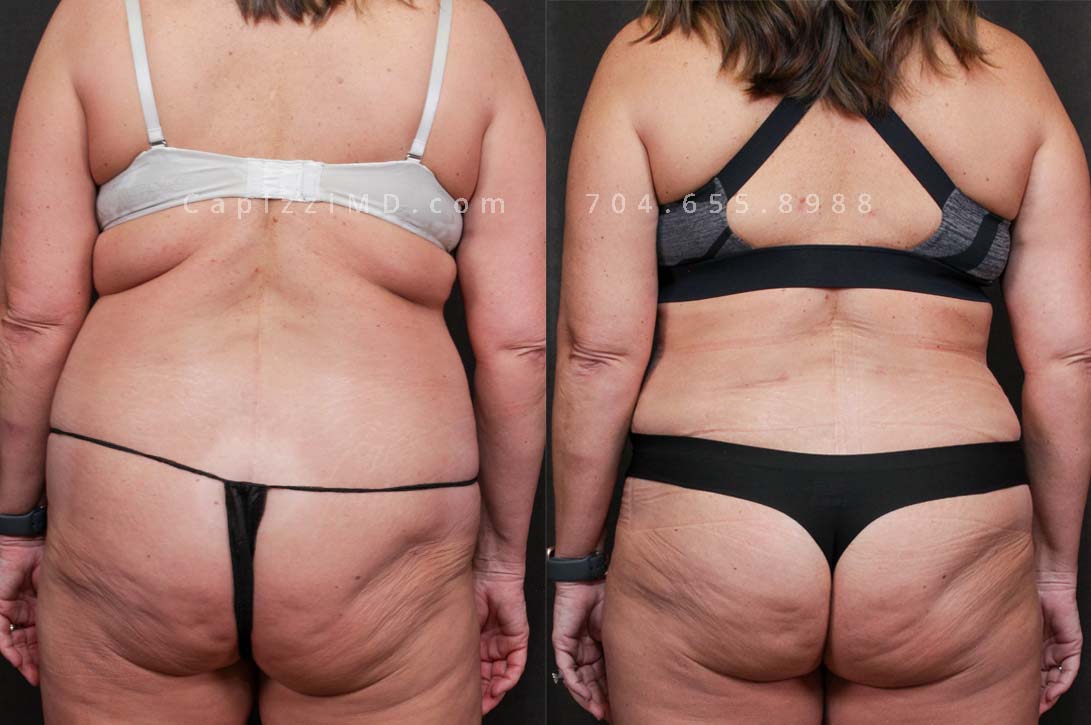 This patient had a standard tummy tuck with liposuction to her abdomen and posterior hips. This procedure gave her a more feminine waist, flatter abdomen, and a more defined, rounded buttocks.