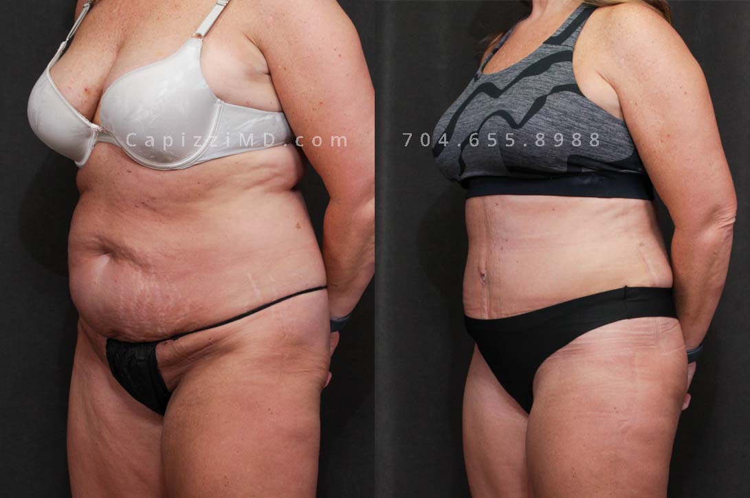 This patient had a standard tummy tuck with liposuction to her abdomen and posterior hips. This procedure gave her a more feminine waist, flatter abdomen, and a more defined, rounded buttocks.