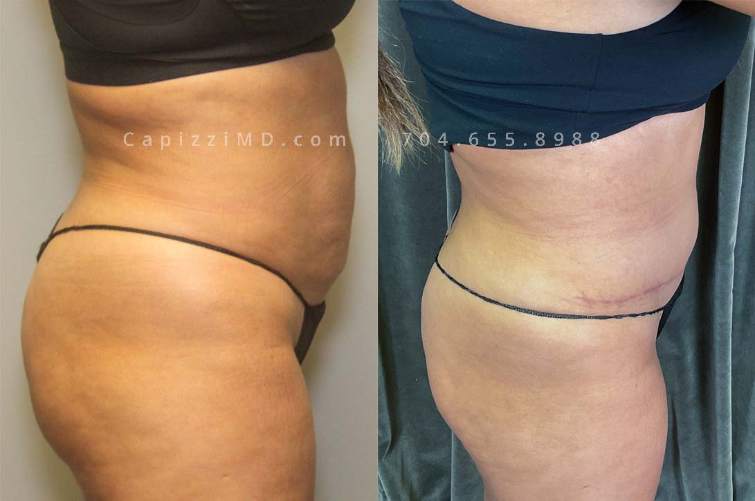 This patient received a standard tummy tuck and liposuction to her hips and lateral thighs. The standard tummy tuck removed stretch marks and scars caused by pregnancy while the liposuction removed excess fat in the love handles and thighs to contour her waist smoothly into her new, slimmer shape.