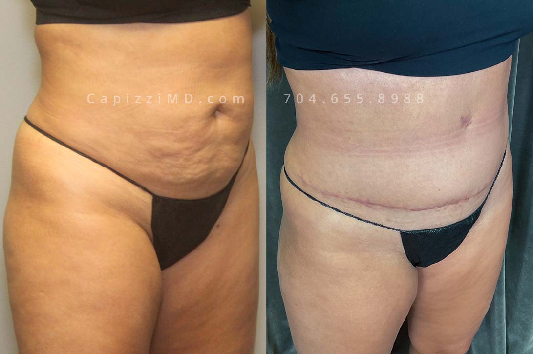 This patient received a standard tummy tuck and liposuction to her hips and lateral thighs. The standard tummy tuck removed stretch marks and scars caused by pregnancy while the liposuction removed excess fat in the love handles and thighs to contour her waist smoothly into her new, slimmer shape.