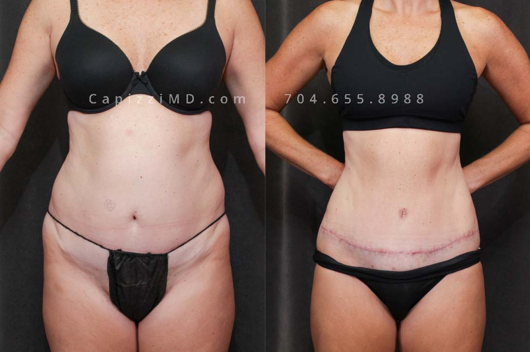This patient had a beautiful result from a standard tummy tuck and liposuction to her abdomen, posterior hips, and inner/outer thighs. You'll notice a slimmer, curvy waist with more definition in her leg muscles.