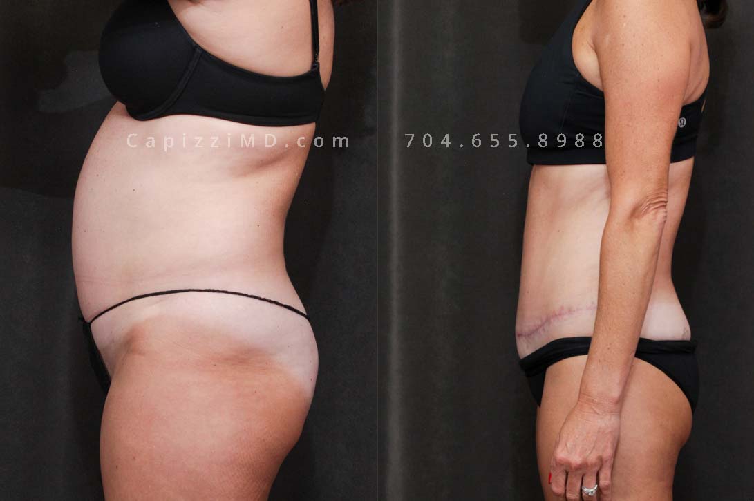 This patient had a beautiful result from a standard tummy tuck and liposuction to her abdomen, posterior hips, and inner/outer thighs. You'll notice a slimmer, curvy waist with more definition in her leg muscles.