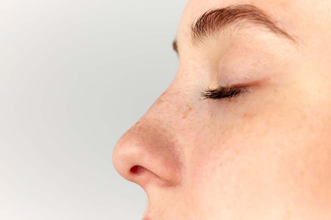 Woman's nose after a Septoplasty. Septoplasty vs. Rhinoplasty