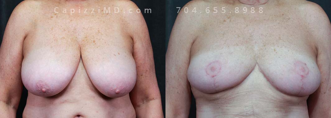 This patient had large breasts her entire life and wanted to reduce their size to alleviate physical symptoms. A breast reduction combined with liposuction to her abdomen, posterior hips, and bra roll reduced the size of her breasts and improved contour in her abdomen.