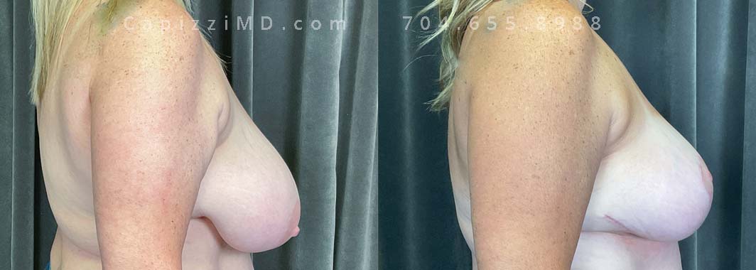This patient was tired of having heavy breasts and wanted a lifted look while maintaining a larger breast size. A breast reduction lifted her nipples, resized her areolas, and removed tissue, all while maintaining a C/D cup. Liposuction to the bra roll created a nice contour to the waist.