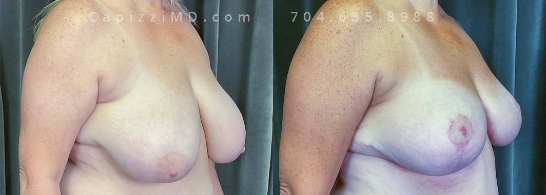 This patient was tired of having heavy breasts and wanted a lifted look while maintaining a larger breast size. A breast reduction lifted her nipples, resized her areolas, and removed tissue, all while maintaining a C/D cup. Liposuction to the bra roll created a nice contour to the waist.