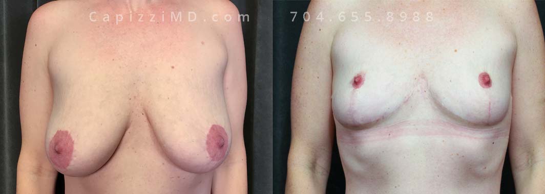 This patient had a breast reduction in the past but was noticing that over the years with child-bearing, they had become large and saggy. A revision breast reduction left her with small breasts (per her desire) and perky nipples.